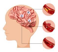 Endovascular Coiling: A Minimally Invasive Solution for Brain Aneurysms - Mohali