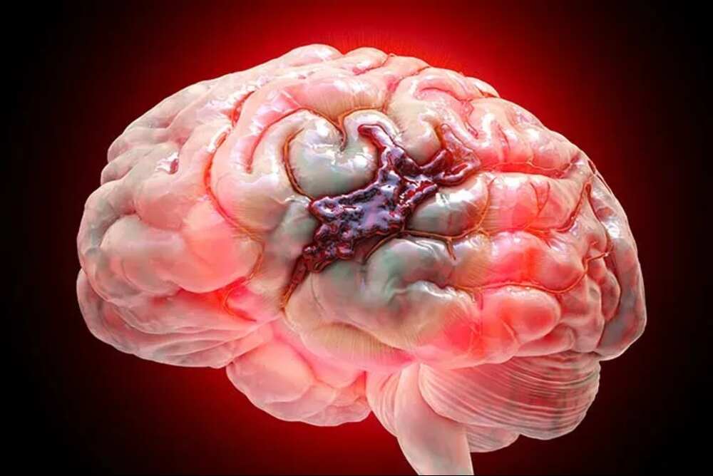 Affordable Brain Hemorrhage Treatment with Advanced Care | IR Facilities - Mohali