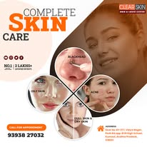 facial port wine stain Treatment in india - Gandhinagar