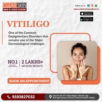 Birthmark removal treatment in india - Hyderabad