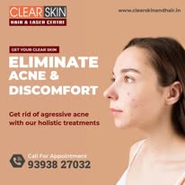 Best Advanced Laser Treatment for Birthmark Removal in India - Hyderabad
