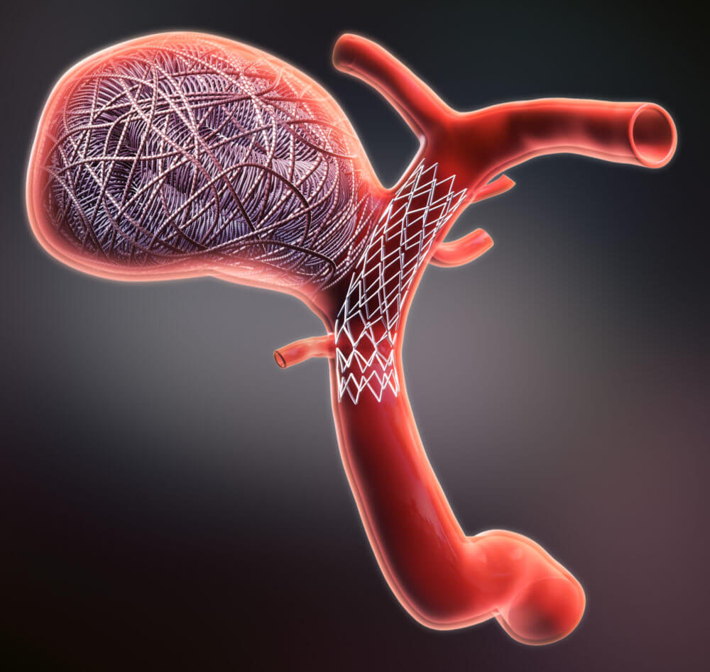 Coiling Surgery for Brain Aneurysm | Advanced Minimally Invasive Care - Mohali