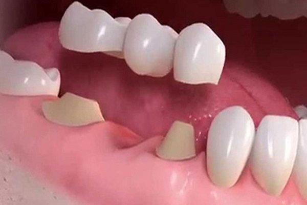 Artificial Teeth Services in Indore Dr Atul Jajoo - Indore