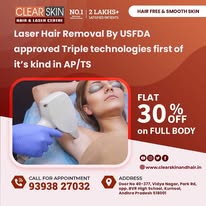 Best Advanced Xanthelasma Treatment in india - Hyderabad