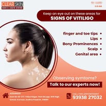 portwine stain treatment in india - Hyderabad